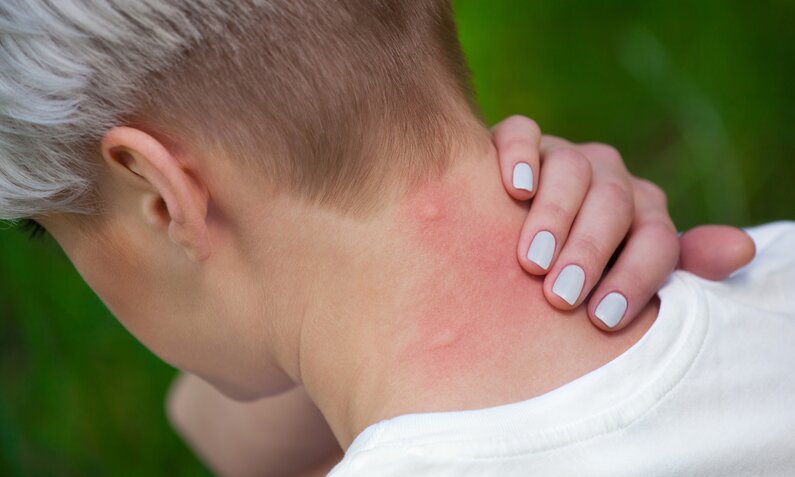 Nahaufnahme einer Person mit weiß lackierten Fingernägeln, die sich den roten, juckenden Nacken kratzt. | © Adobe Stock/ Dimid